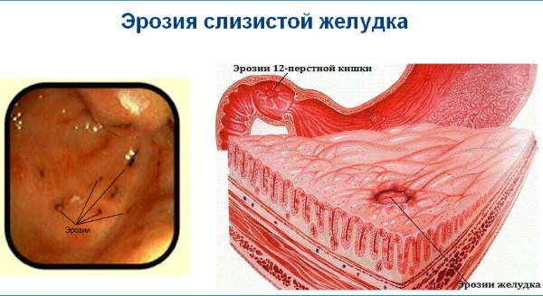 Отрыжка воздухом после еды. Причины и лечение народными средствами, лекарства, если сильная, без запаха, тошнота, ком в горле