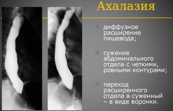 Отрыжка воздухом после еды. Причины и лечение народными средствами, лекарства, если сильная, без запаха, тошнота, ком в горле