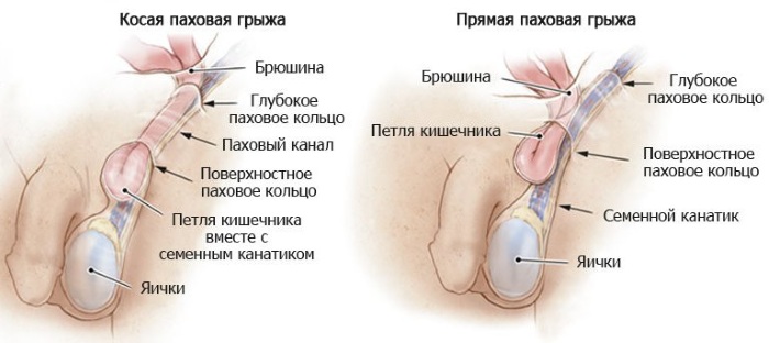 Паховая грыжа у мужчин. Лечение без операции народными средствами, бандаж, по методу Бубновского, Болотову, Неумывакина. Симптомы, последствия