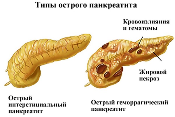 Схема лечения панкреатита у взрослых лекарствами