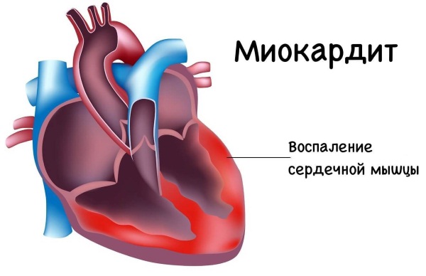 Пазухи носа. Строение, анатомия в картинках. Симптомы воспаления, отека придаточных, гайморовых