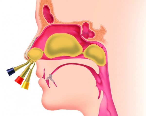 Пазухи носа. Строение, анатомия в картинках. Симптомы воспаления, отека придаточных, гайморовых