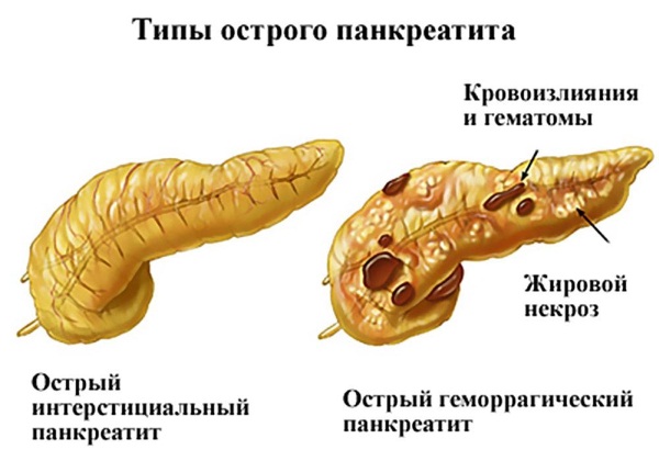 Печеночные колики. Симптомы у женщин, первая помощь, как снять приступ, диета, лечение препаратами