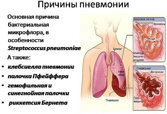 Пневмония. Симптомы, виды и лечение у взрослых. Препараты и народные средства