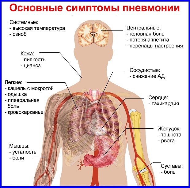 Пневмония. Симптомы, виды и лечение у взрослых. Препараты и народные средства