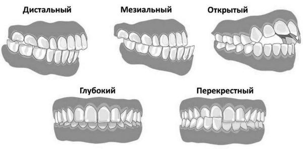 Повышенное слюноотделение. Причины у женщин, как уменьшить, при беременности, ночью, при простуде, гастрите, после еды, перед месячными. Регуляция