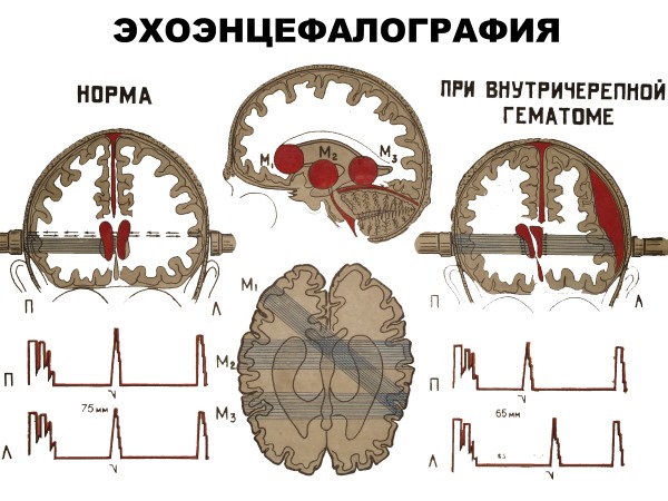 Прединсультное состояние у женщин, мужчин. Первые признаки, основные симптомы. Чем лечить, последствия