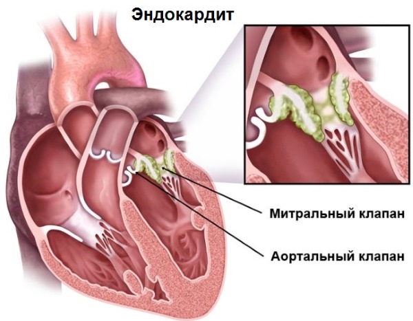 Причины сильного потоотделения (гипергидроза) у женщин по ночам, всего тела, головы, подмышек. Как избавиться, лечение народными средствами, препараты