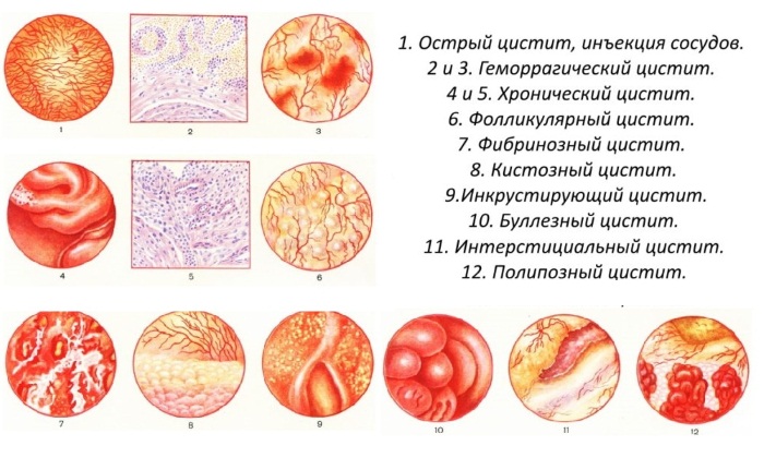 Признаки цистита у женщин. Симптомы, причины и лечение у женщин. Народные средства, препараты в таблетках