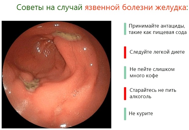 Прыщ под языком болит горло thumbnail