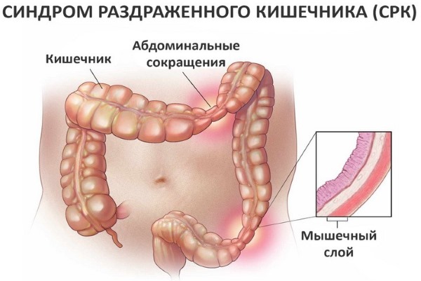 Раздраженный кишечник. Симптомы и лечение у взрослых народными средствами, препараты, диета