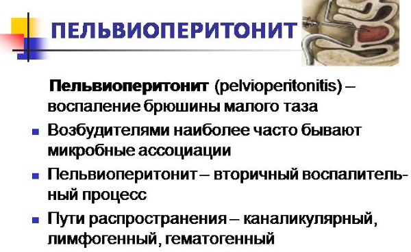 Сальпингоофорит. Что это такое, хронический, двусторонний, острый. Причины, симптомы и лечение у женщин