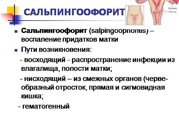 Сальпингоофорит. Что это такое, хронический, двусторонний, острый. Причины, симптомы и лечение у женщин