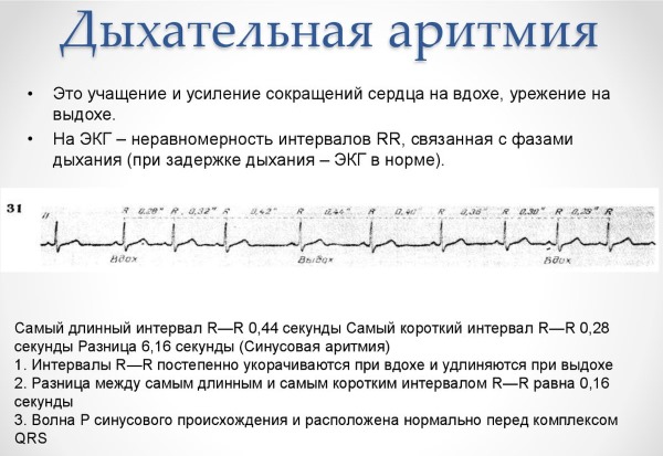 Сердечная аритмия: мерцательная, желудочковая, пароксизмальная. Первая помощь, симптомы и лечение: таблетки, народные средства