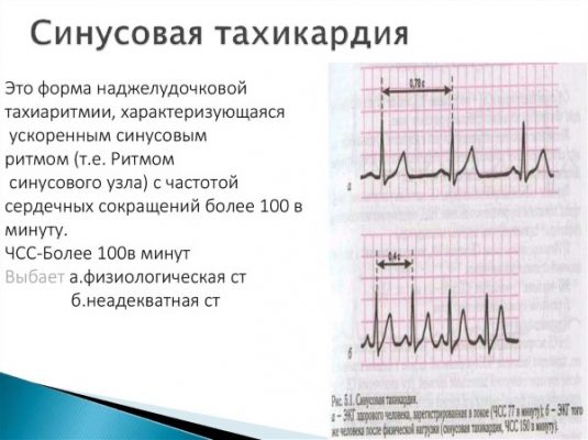 Пароксизмальная мерцательная аритмия карта вызова смп