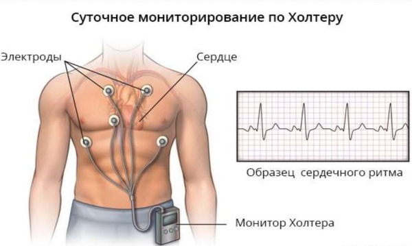 Сердечная аритмия: мерцательная, желудочковая, пароксизмальная. Первая помощь, симптомы и лечение: таблетки, народные средства