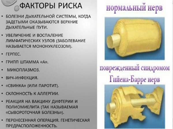 Синдром Гийена-Барре. Что это, причины, симптомы, лечение, диагностика болезни