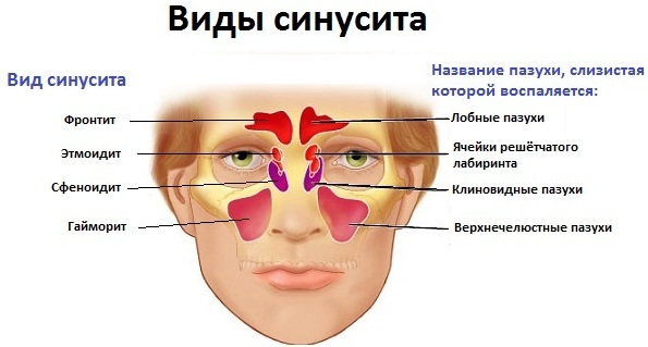 Синусит у ребенка. Симптомы и лечение народными средствами, препараты. Признаки хронического, гнойного, как определить