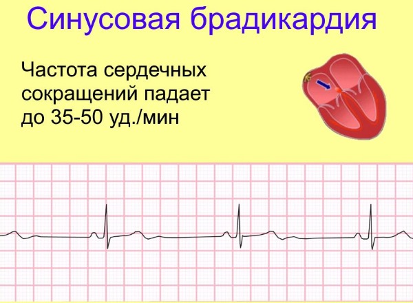 Брадикардия на фоне высокого давления