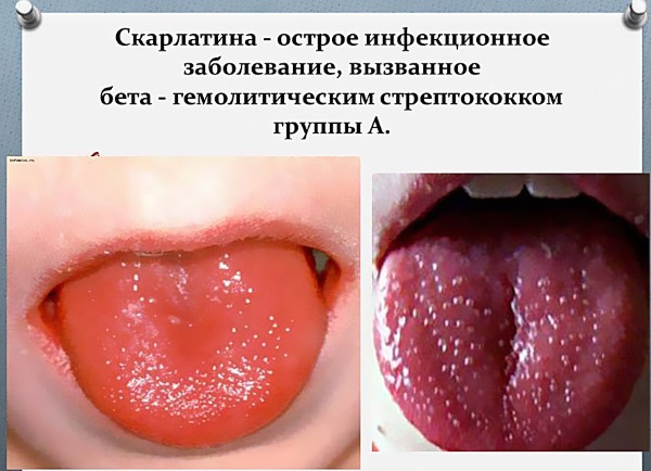 Скарлатина у взрослых. Симптомы и лечение, профилактика, признаки, как передается