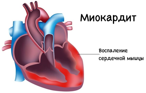 Скарлатина у взрослых. Симптомы и лечение, профилактика, признаки, как передается