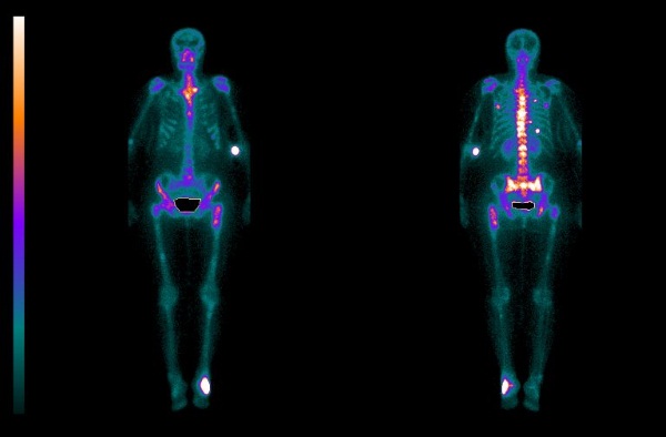 Сцинтиграфия костей скелета что это такое вред