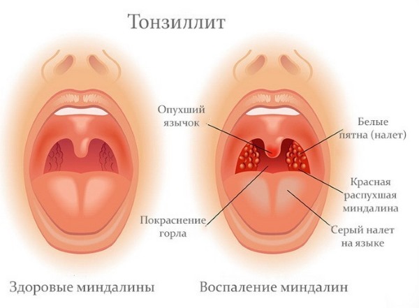 Тонзиллит. Симптомы и лечение у взрослых народными средствами, антибиотиками, гомеопатия. Как лечить хронический, вирусный