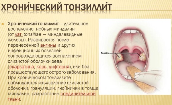 Тонзиллит фото горла симптомы