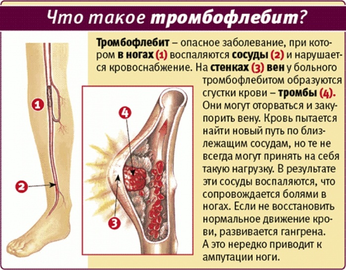 Тромбофлебит нижних конечностей. Симптомы и лечение мазью, народными средствами, препараты, питание. Прогноз