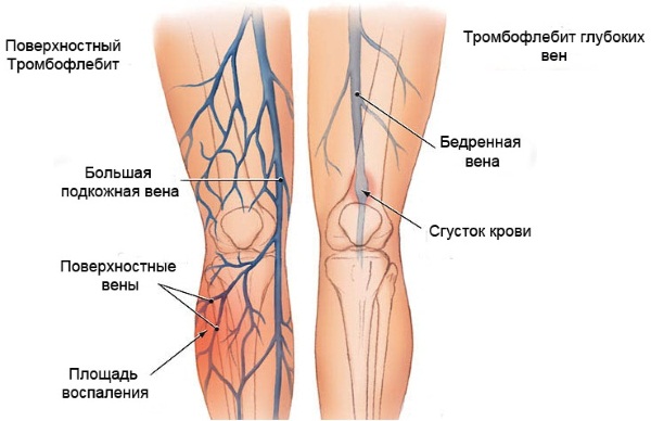 Тромбофлебит нижних конечностей. Симптомы и лечение мазью, народными средствами, препараты, питание. Прогноз