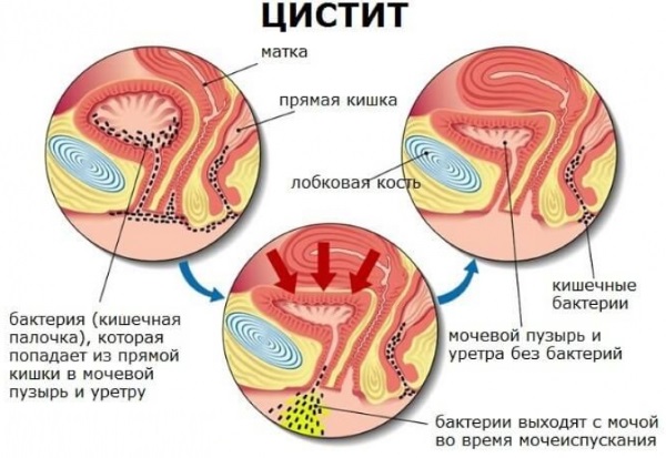 Цистит у женщин при беременности. Симптомы, лечение. Препараты, народные средства, антибиотики