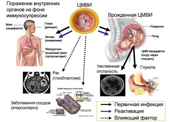 Цитомегаловирусная инфекция у детей. Симптомы и последствия, врожденная, хроническая, острая форма, лечение