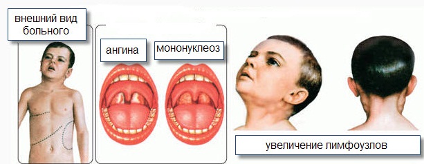 Цитомегаловирусная инфекция у детей. Симптомы и последствия, врожденная, хроническая, острая форма, лечение