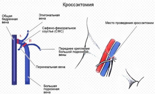 Варикозное расширение вен пищевода лечение препараты схема лечения