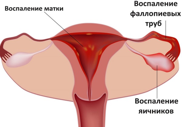 Воспаление придатков у женщин. Симптомы и лечение народными средствами, антибиотиками, свечами, травами