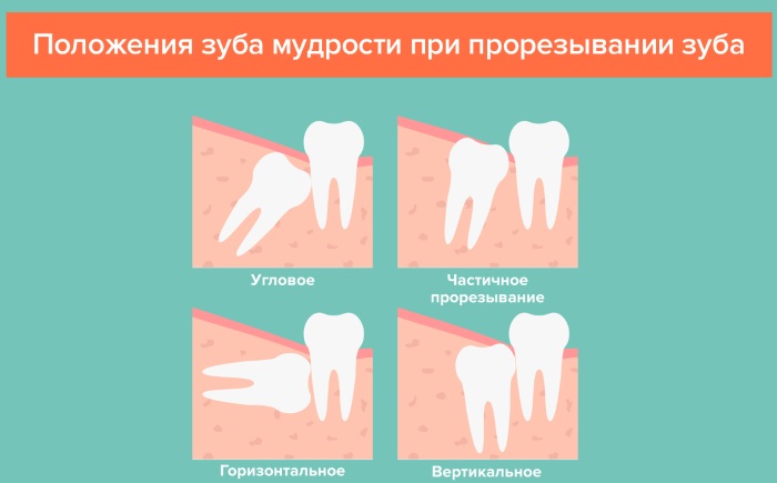 Возраст, когда растет зуб мудрости. Что делать, если болит и опухла десна, щека