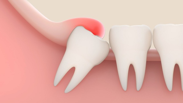 Возраст, когда растет зуб мудрости. Что делать, если болит и опухла десна, щека