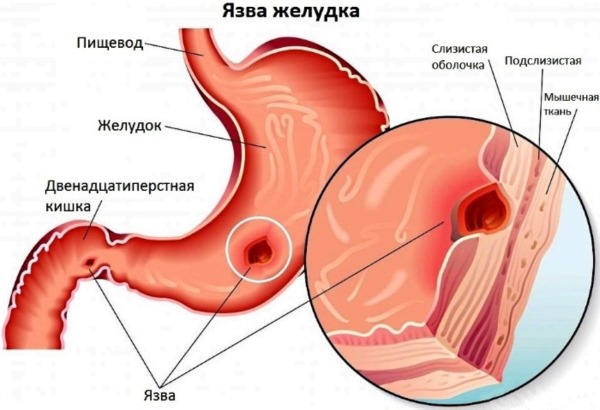 Язва желудка. Симптомы и лечение у взрослых народными средствами, препаратами, по Неумывакину, диета, операция, питание