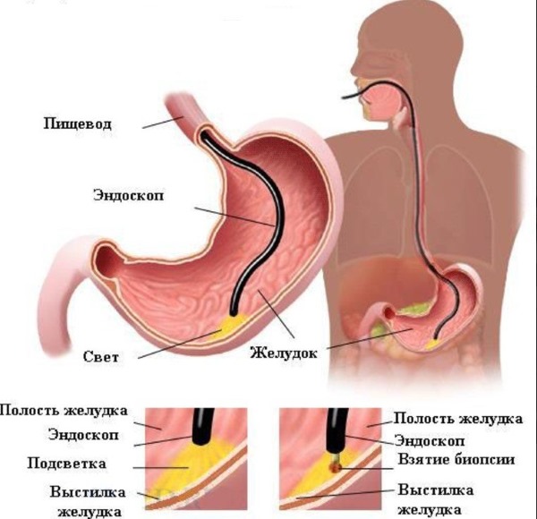 Язва желудка. Симптомы и лечение у взрослых народными средствами, препаратами, по Неумывакину, диета, операция, питание