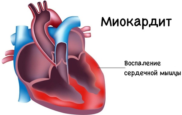 Жжение в грудине посередине, слева. Причины у женщин, если тяжело дышать, отрыжка. Что это может быть, лечение