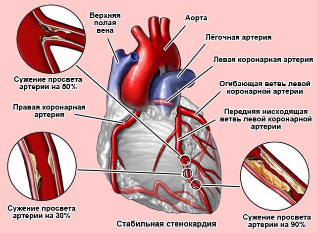 Жжение в грудине посередине, слева. Причины у женщин, если тяжело дышать, отрыжка. Что это может быть, лечение