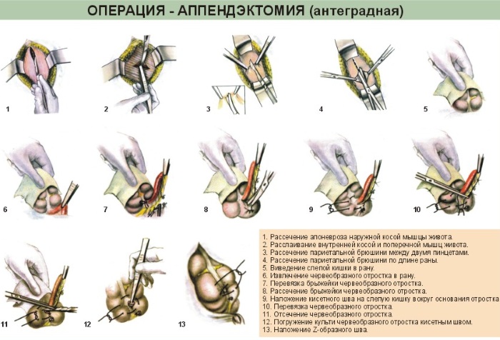 Аппендицит. Симптомы у детей 10-11-12-13 лет, с какой стороны, как определить, признаки, клинические рекомендации