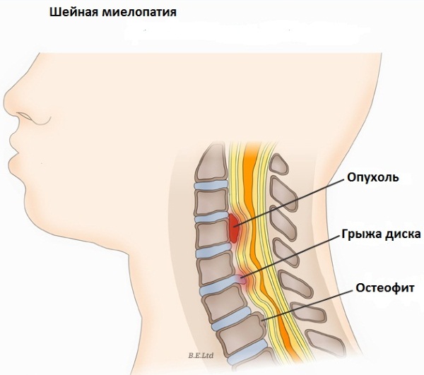 Болит шея сзади, слева, справа, сбоку. Причины, чем лечить