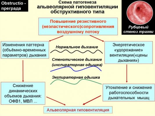 Дыхательная недостаточность лечение презентация