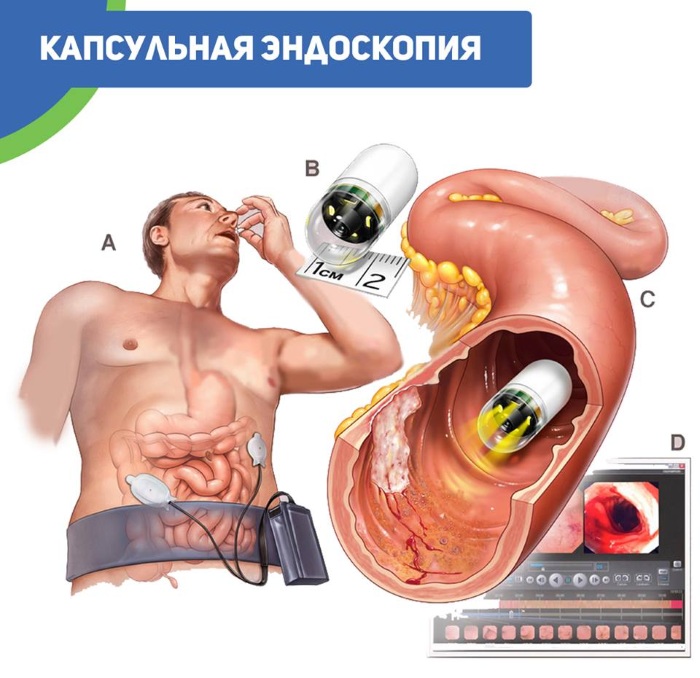 Эндоскопия желудка видеокапсульная. Что это, подготовка кишечника, алгоритм проведения. Цена процедуры