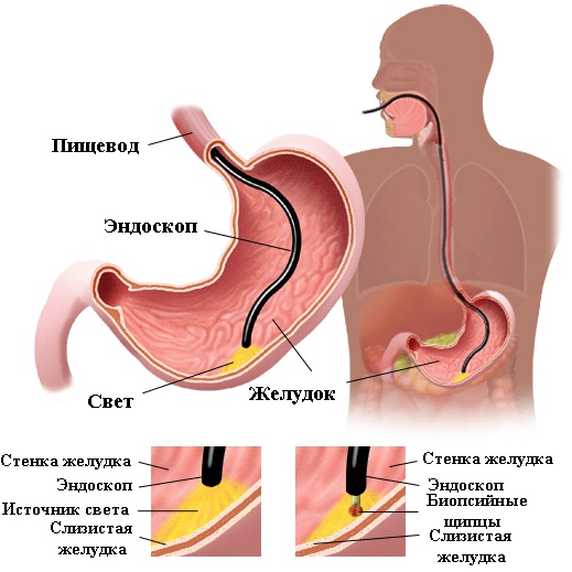 Эндоскопия желудка видеокапсульная. Что это, подготовка кишечника, алгоритм проведения. Цена процедуры