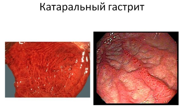 Гастрит у ребёнка. Симптомы и лечение, признаки. Диета, народные средства, препараты, меню