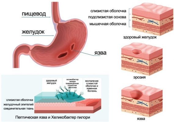 У ребенка гастрит 5 стол