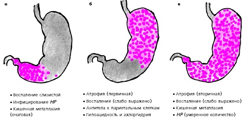 Гастрит у ребёнка. Симптомы и лечение, признаки. Диета, народные средства, препараты, меню