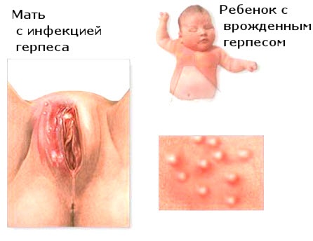 Герпес на лице. Фото, виды, стадии, лечение у ребенка, взрослого, причины возникновения